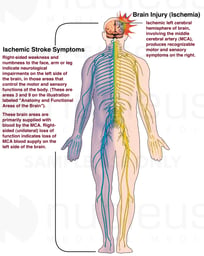 Contralateral (Opposite-side) Effect of Brain Injury