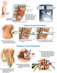 Lumbar Spine Injury with Anterior and Posterior Spinal Fusion