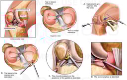 Arthroscopic Knee Surgery