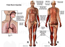 Fatal Burn Injuries