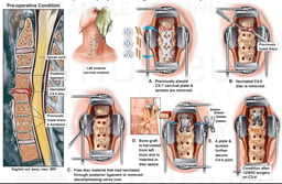 Cervical Spine Injury with Surgical Discectomy and Fusion