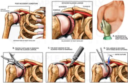 Post-accident Right Shoulder Glenoid Labrum Injury with Surgical Repairs