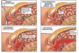 Vaginal Hysterectomy with Fatal Post-operative Hemorrhage