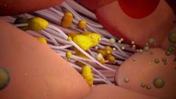 Hyperlipidemia (High Cholesterol)