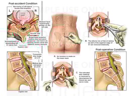 Lumbar Spine Injury with Surgical Repairs