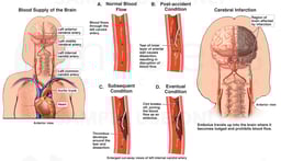 Internal Carotid Artery Dissection with Subsequent Cerebral Embolism