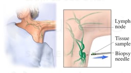 Core Lymph Biopsy