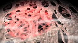 Glaucoma Surgery: Laser Trabeculoplasty