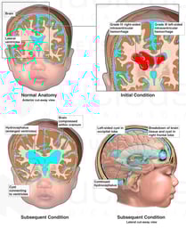 Progression of Brain Injury