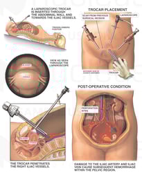 Laparoscopic Trocar Placement with Iatrogenic Injury to Iliac Artery and Vein
