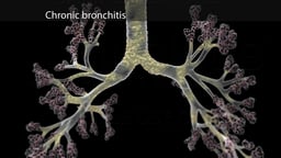 Chronic Bronchitis: Mucus Buildup and Airway Inflammation