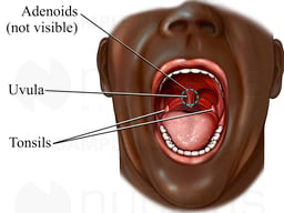 Tonsils and Adenoids