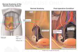 Laparoscopic Oophorectomy with Transection of the Right Ureter