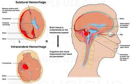 The Results of Intracranial Hemorrhage