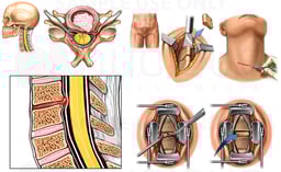 C5-6 Anterior Cervical Discectomy and Fusion