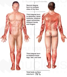 Severe Burn Injuries with Multiple Graft Harvest Sites