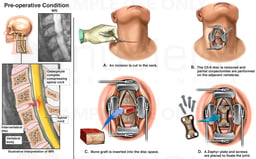 Cervical Spine Injury with Surgical Discectomy and Fusion