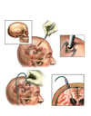 Brain Surgery - Ventriculostomy and Placement of Intracranial Pressure (ICP) Monitor Bolt