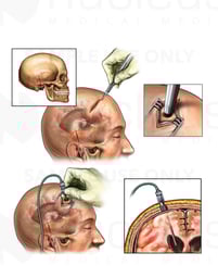 Brain Surgery - Ventriculostomy and Placement of Intracranial Pressure (ICP) Monitor Bolt