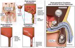 Male Urological Injuries with Subsequent Reconstructive Surgeries to the Bladder and Urethra