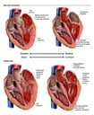 Normal Heart vs. Heart with Mitral Valve Insufficiency