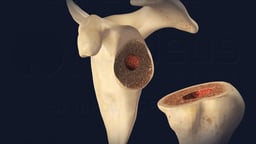 Scapula and Humerus: Preparation for Reverse Shoulder Replacement