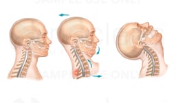 Interpretation of Whiplash Mechanics from Grauer et al. (Spine, 1997)