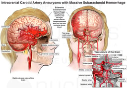 Intracranial Carotid Artery Aneurysms with Massive Subarachnoid Hemorrhage