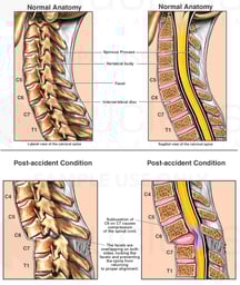 Spinal Cord Injury - Cervical Subluxation (Neck Vertebrae Overlap) and Bilateral Facet Lock