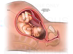 exh81490 Nuchael Cord around the baby’s neck