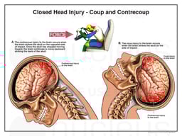 Closed Head Traumatic Brain Injury (TBI) - Coup and Contrecoup