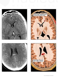 Traumatic Brain Injuries