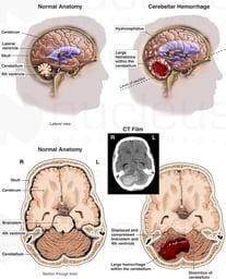 Intracranial Hemorrhage