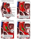 Normal vs Defective Aortic Valve