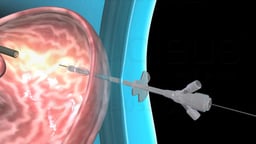 Push Method of Percutaneous Endoscopic Gastrostomy (PEG)