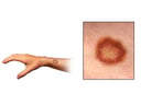 Ringworm Rash