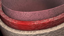Aortic Aneurysm and Dissection