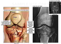 Fracture of Left Tibia
