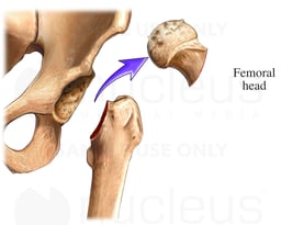 THR: Femoral Head Removal