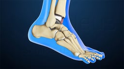 Ankle Replacement