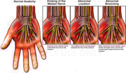 Anatomical Variations of the Median Nerve