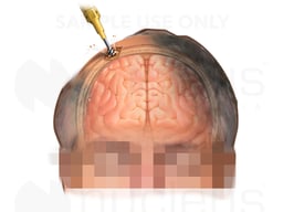 Drill Creating Hole in Skull for ICP