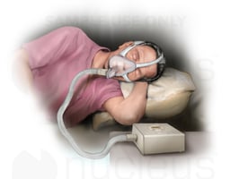 Sleep Apnea