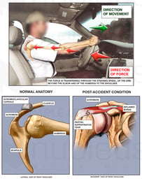 Mechanism of Shoulder Injury In Motor Vehicle Accident (MVA)