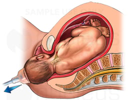 Birth Injury - Shoulder Dystocia Using Vacuum Extractor Delivery