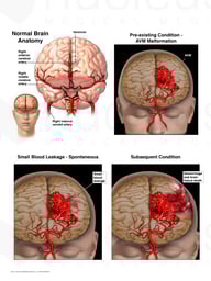 Rupture of Cerebral Arteriovenous Malformation (AVM)