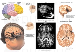 Condition Subsequent to Traumatic Brain Injury