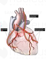 Heart Bypass