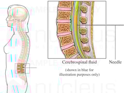Spinal Tap - Lumbar Puncture Method