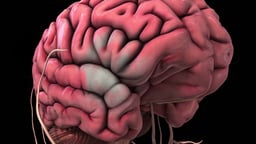 Transient Ischemic Attack (Stroke) of Brain